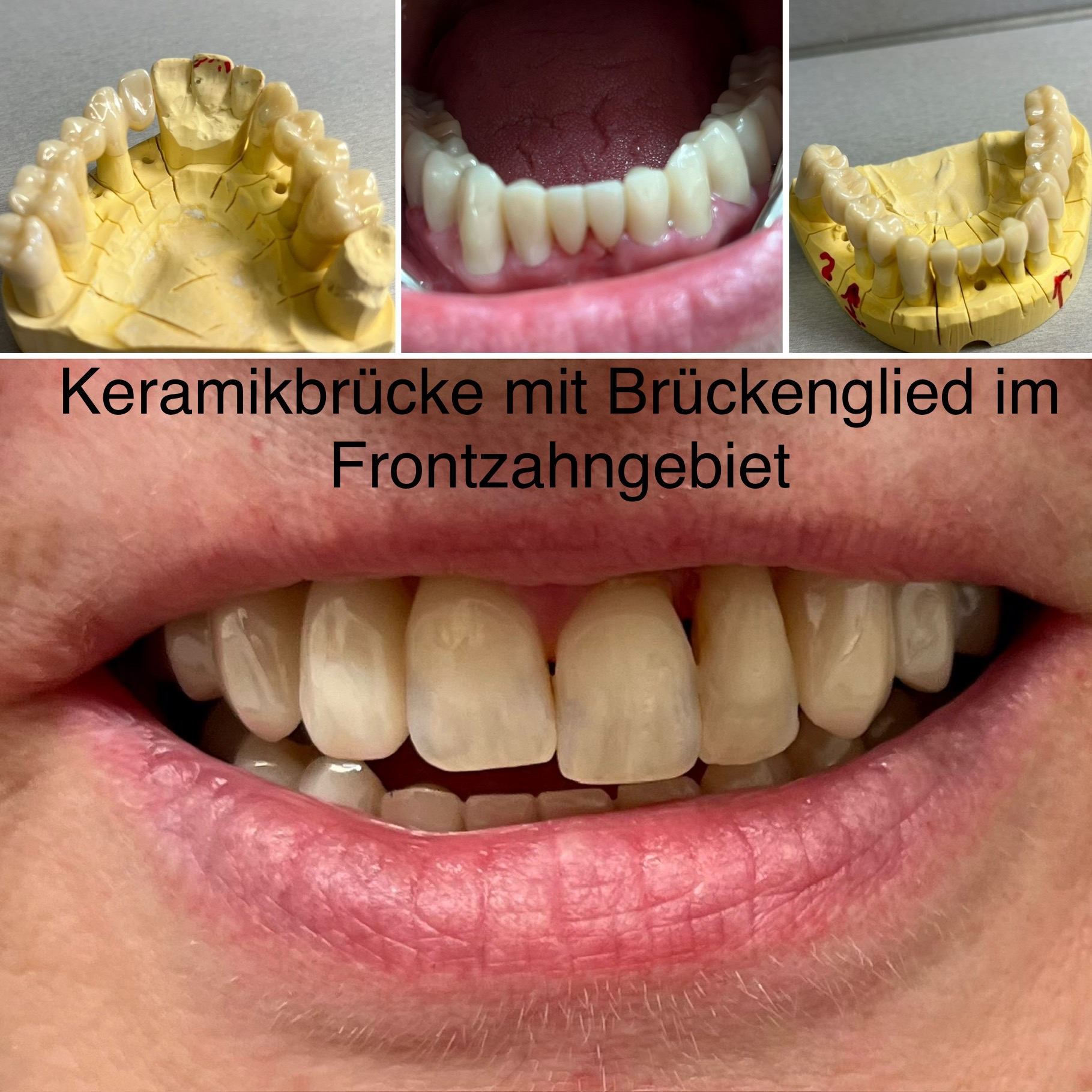 Keramikbrücke mit Frontzahnbrückenglied