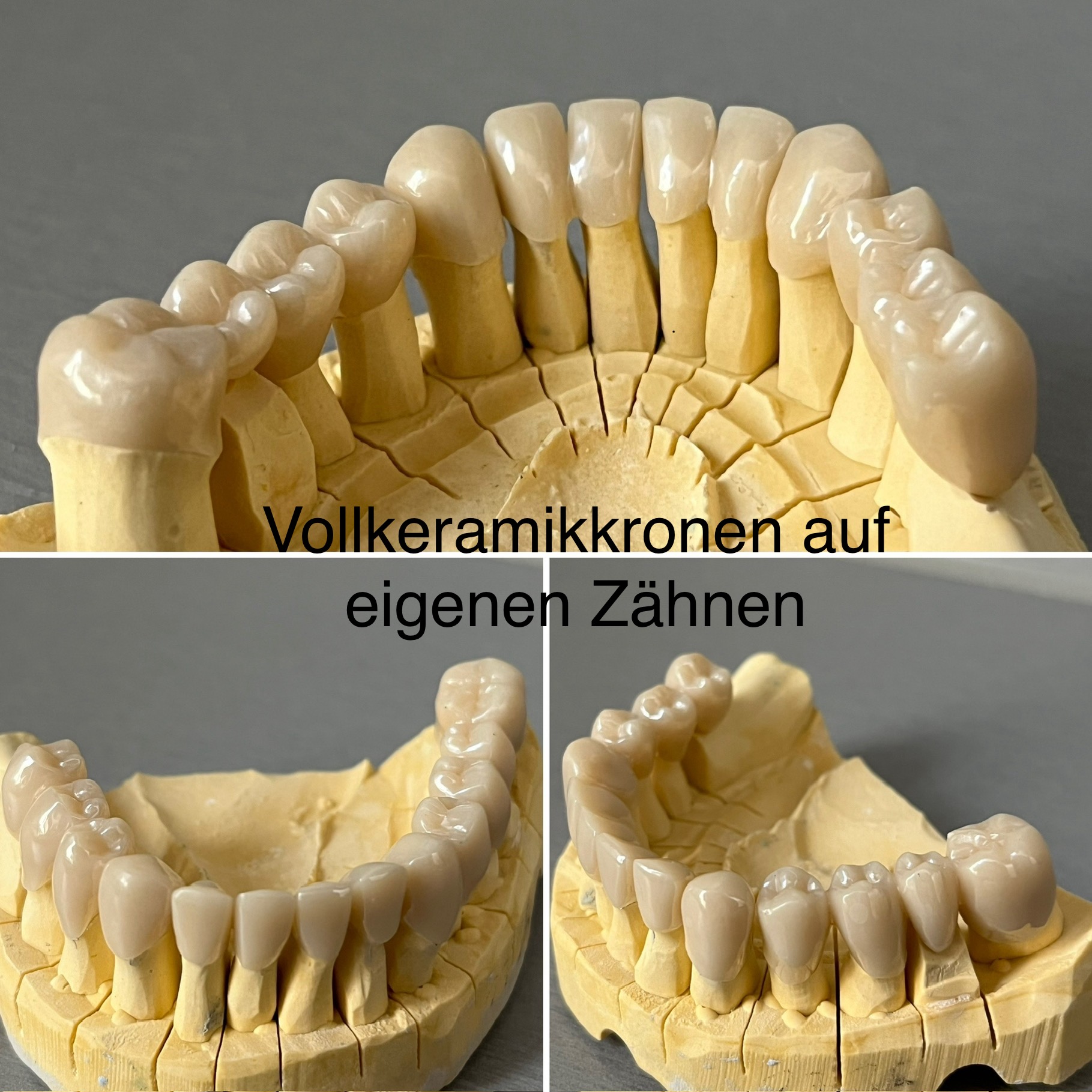 Vollkeramikkronen auf eigenen Zähnen